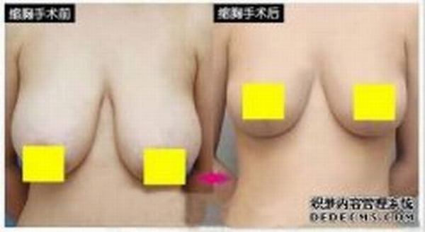 什么样的乳房为乳房过大?