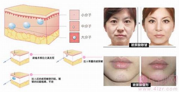 北京八大处丁小邦除皱整形怎么样？多少钱？