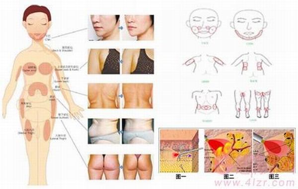 北京八大处丁小邦除皱整形怎么样？多少钱？