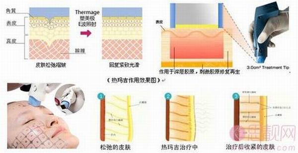 北京八大处丁小邦除皱整形怎么样？多少钱？