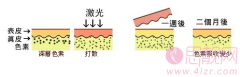 苏州激光祛斑一般多少钱