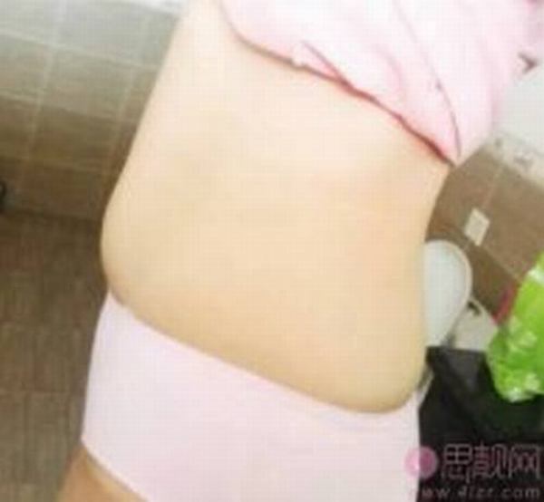 腰腹部吸脂恢复日记