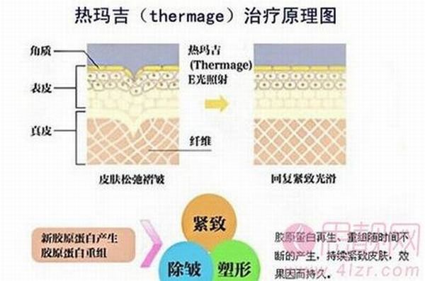 热玛吉原理