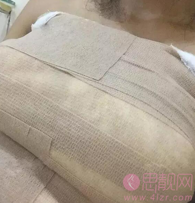 杭州麦格假体隆胸恢复变美丽女人