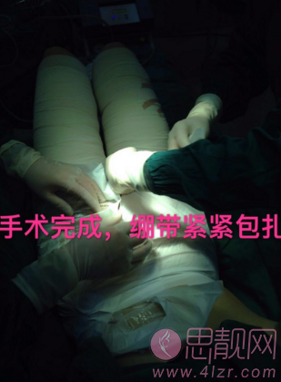 北京大腿环吸脂瘦腿恢复案例