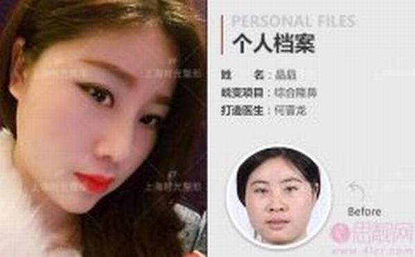 自卑丑鼻女整形逆袭大翻身 上海时光鼻部综合整形