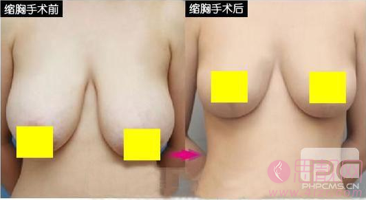 乳房缩小手术是什么