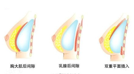 隆胸需要多少钱