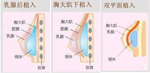 假体隆胸影响哺乳吗？术后有哪些需要注意？