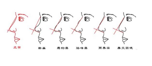 怎样改变鹰钩鼻子？整形方法有哪些？