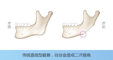 下颌角切除费用要多少？怎么护理？