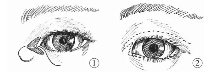 内眦赘皮做哪种双眼皮类型好