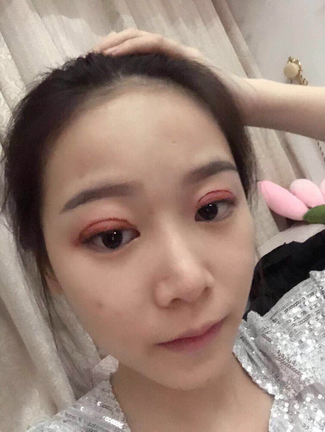 绍兴维美整形美容医院价格表，附双眼皮真人案例