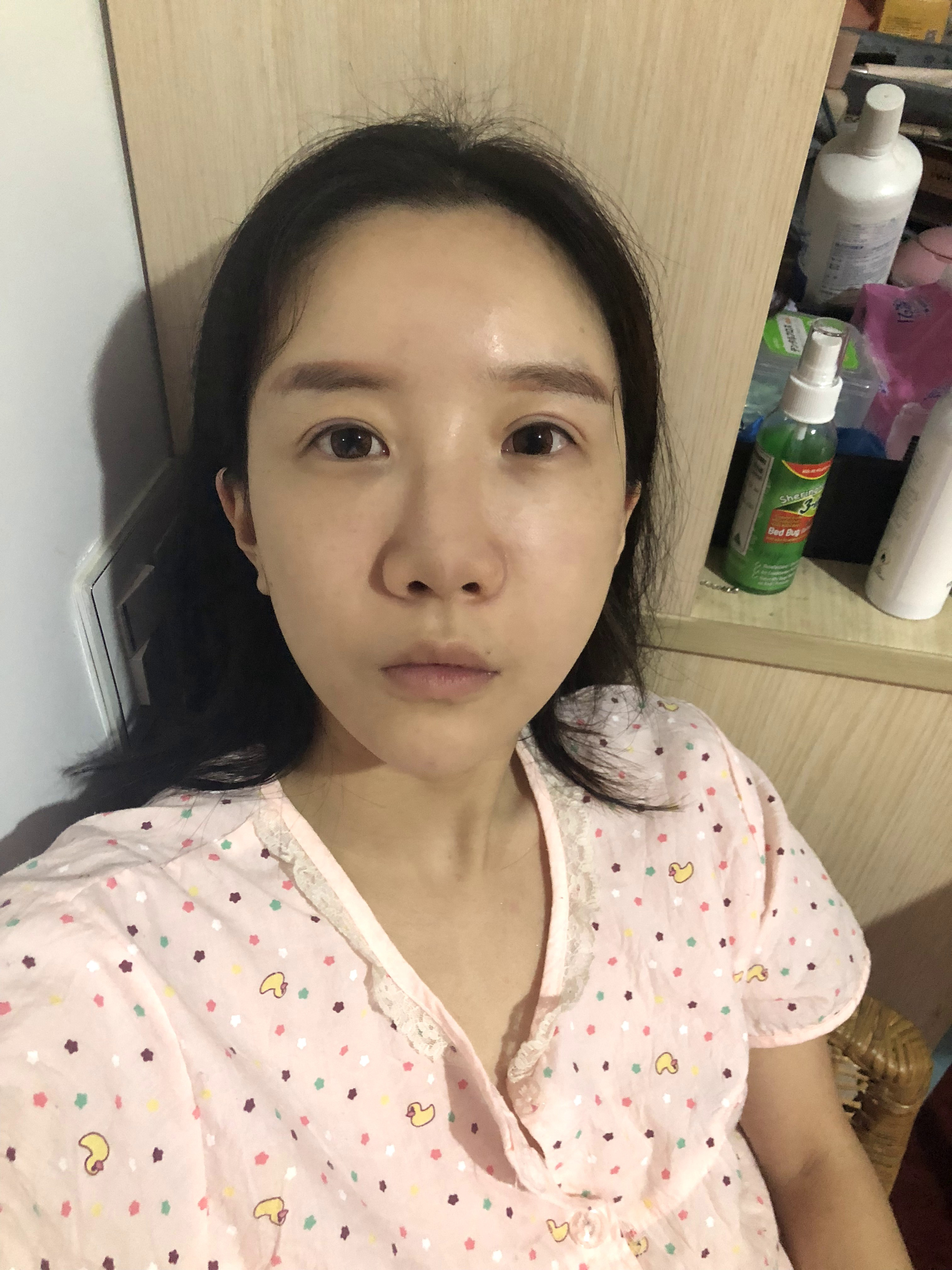 苏州美莱医疗美容医院张亮做鼻子怎么样？附价格表及案例效果图