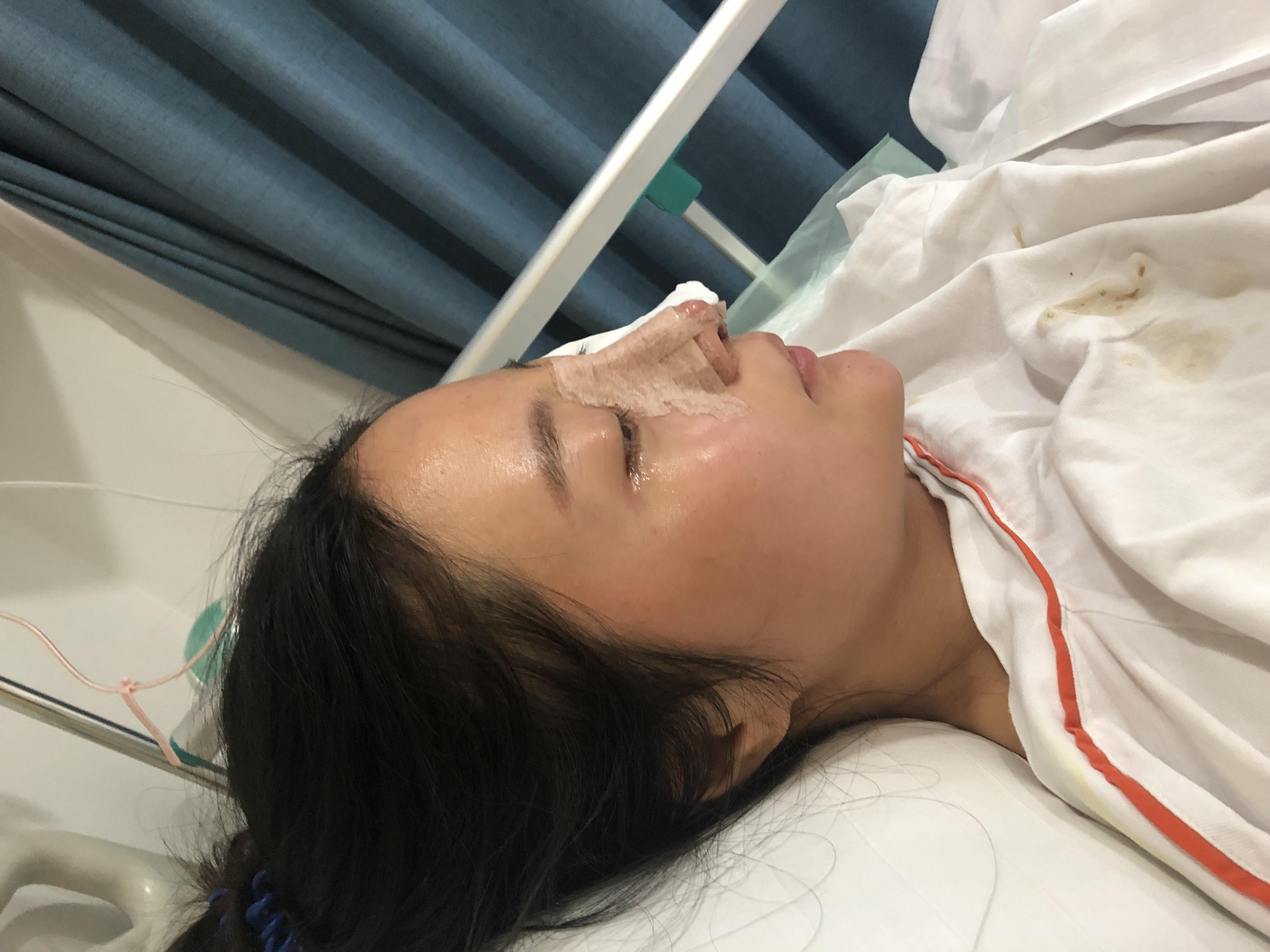 上海伯思立医疗美容门诊部李茂群隆鼻好吗？附肋软骨隆鼻案例