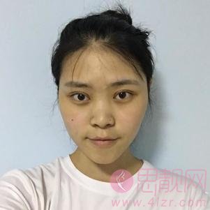  重庆联合丽格美容医院欧阳春做鼻子怎么样，附隆鼻案例及价格表