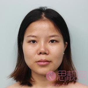 临沂东方美莱坞整形申云隆鼻怎么样？附价格表查询及案例分享