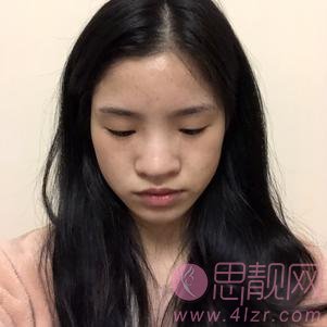 成都天使之翼吴开泉做隆鼻怎么样？附价格表及案例效果展示