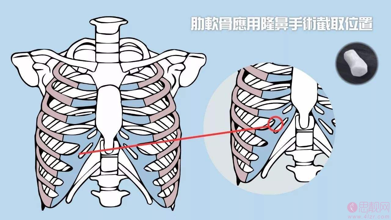 肋软骨隆鼻会吸收吗