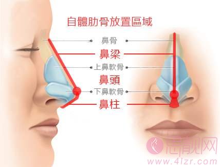 肋软骨隆鼻多久可以恢复自然状态