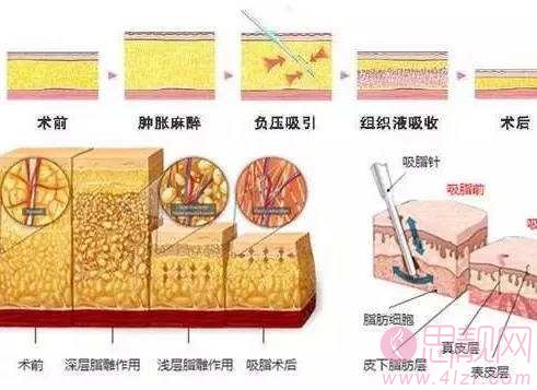 腰腹吸脂多久消肿见到效果