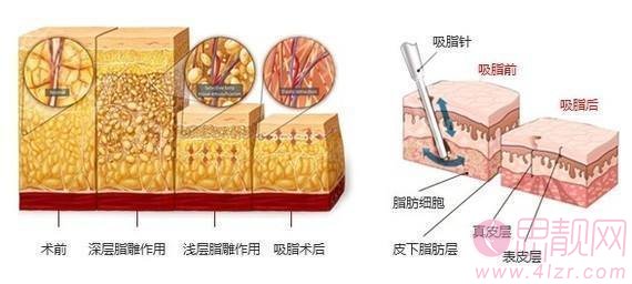 腰腹吸脂后还会反弹吗？