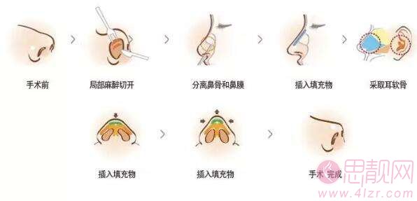 肋软骨隆鼻和耳软骨隆鼻哪个好