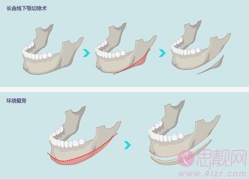 磨下颌角和切下颌角的区别