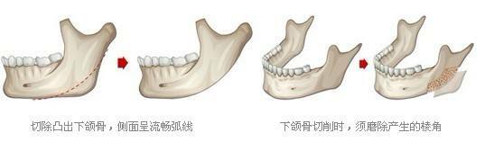 磨下颌角和切下颌角的区别