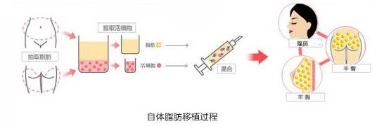 自体脂肪隆鼻多少钱