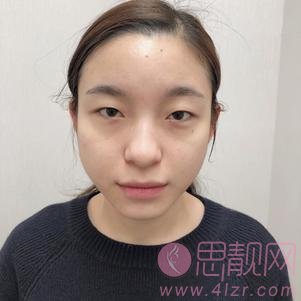 成都恩美医学美容医院2020价格表一览+张小虎双眼皮案例