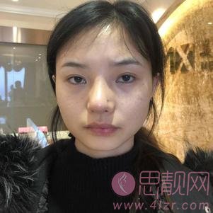 成都美熹医疗美容刘家亘硅胶垫下巴怎么样？2020价格表一览