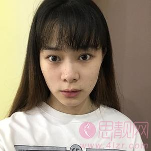 成都润美玉之光医疗美容黄开亮隆鼻怎么样？2020价格表一览