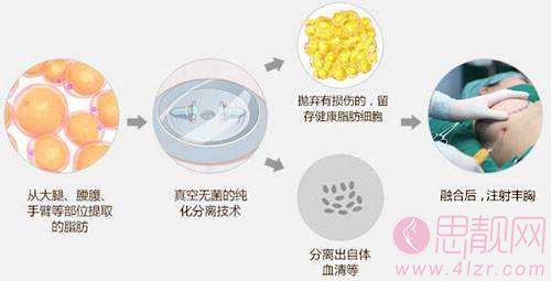 科普 | 假体丰胸和自体脂肪丰胸的区别