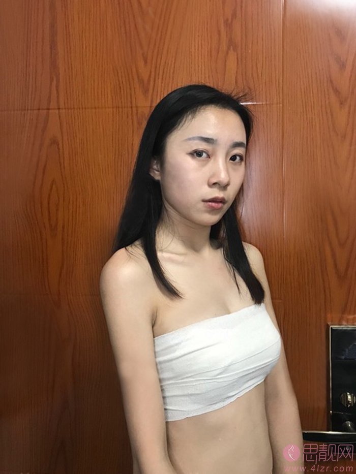 福州优医联合医美医疗美容隆胸怎么样？附2020价格表一览+隆胸前后对比