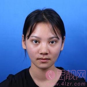 大连沙医生整形美容口腔专科医院吴紫权隆鼻怎么样？附隆鼻案例及2020价格表曝光