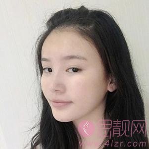 北京凯润婷医疗美容医院胡彬隆鼻怎么样？2020价格表一览+隆鼻案例前后对比