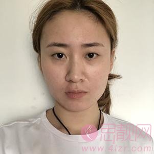 兰州三爱整形美容段世玉做双眼皮怎么样？2020价格表一览