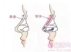 假体隆鼻手术有副作用吗？