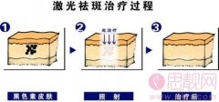 激光祛斑会反弹吗？