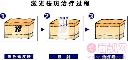 激光祛斑之后会反弹吗？ 