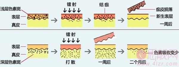 激光祛斑会反弹吗？