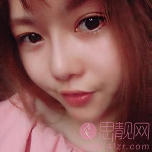 上海华晋医疗美容门诊部孙建斌隆鼻如何？2020价格表一览+隆鼻前后对比案例