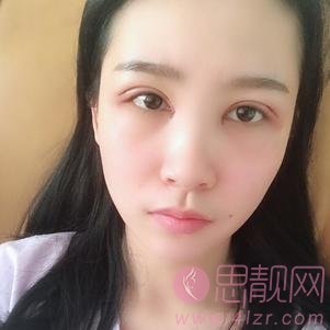 上海华美医疗美容医院杨亚益做双眼皮好不好？附双眼皮真人分享及2020价格表上线