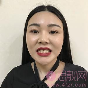 上海华美医院齿科牙齿美白多少钱？2020价格表曝光+牙齿美白真人案例分享