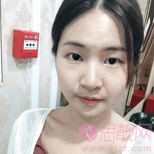 上海李斌医疗美容李斌做下眼下至术好不好？2020价格表曝光+下眼下至术前后对比分享