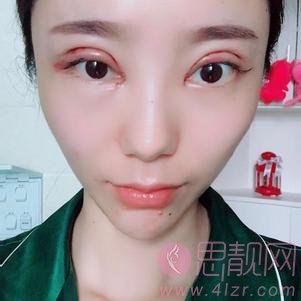 成都美容整形医院王立鹏做双眼皮怎么样？2020价格表曝光+双眼皮真人案例分享