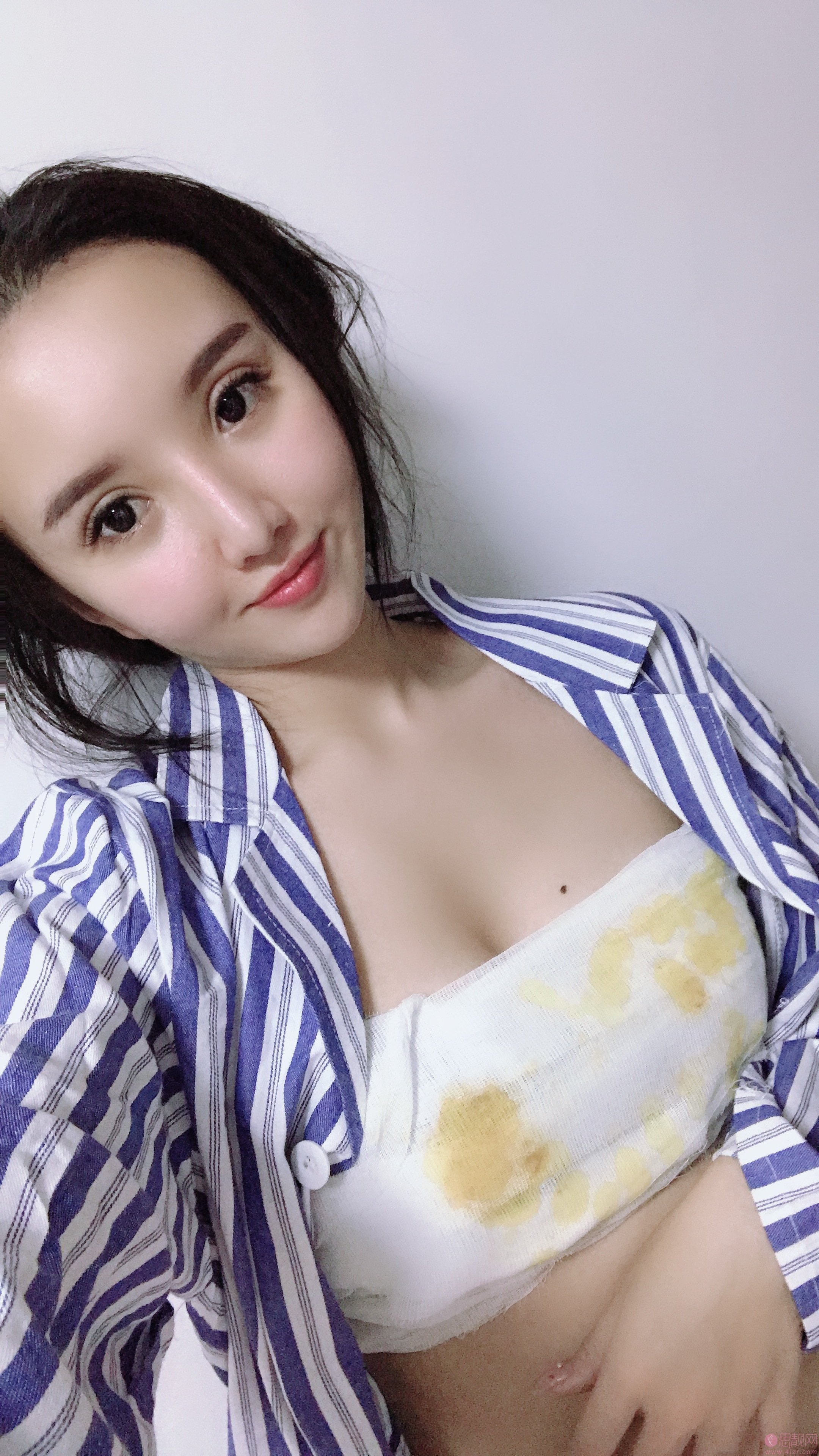 成都美绽美整形美容医院何一波假体隆胸怎么样？2020价格表曝光+隆胸真人分享