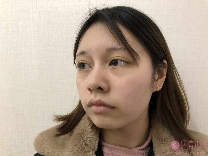 厦门欣医美医疗美容做面部吸脂怎么样？2020价格表曝光+面吸真人案例分享