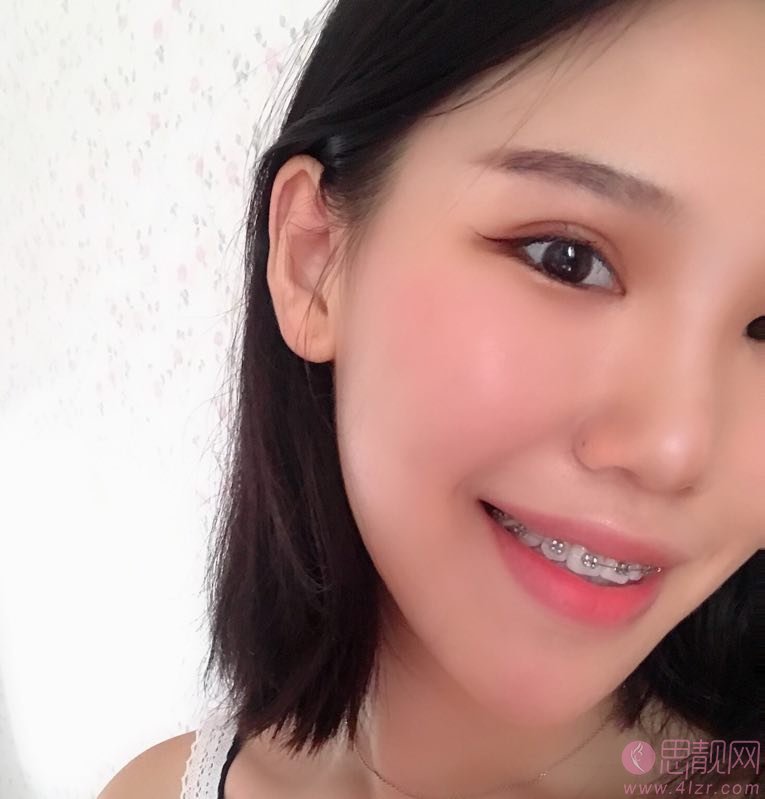 杭州格莱美医疗美容医院隐形牙齿矫正多少钱？2020价格表曝光+矫正牙齿真人案例分享